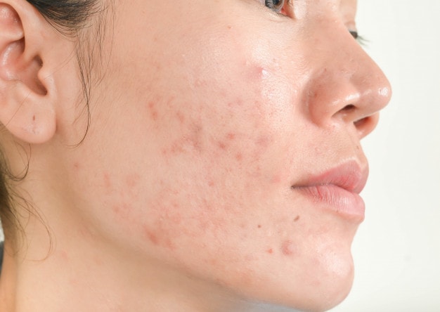 Dermatologo specializzato in acne