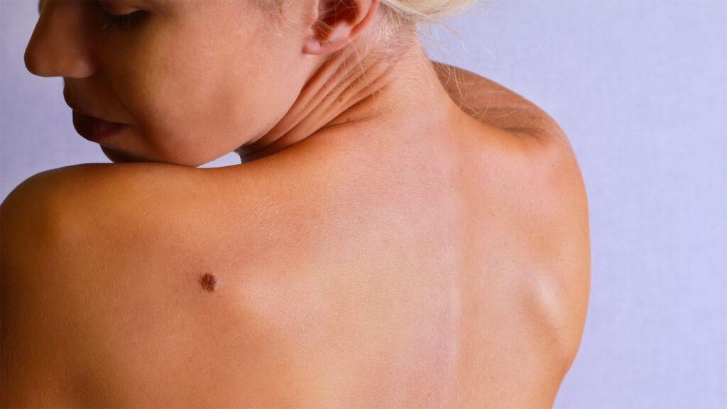 In quanto tempo degenera un Melanoma?
