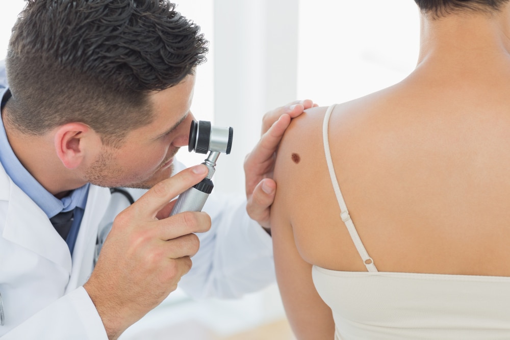 Melanoma cosa fare?