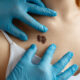 Melanoma cosa fare?