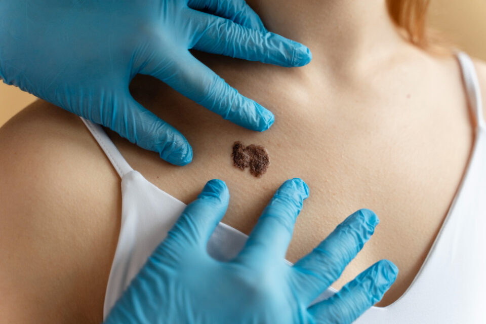 Melanoma cosa fare?