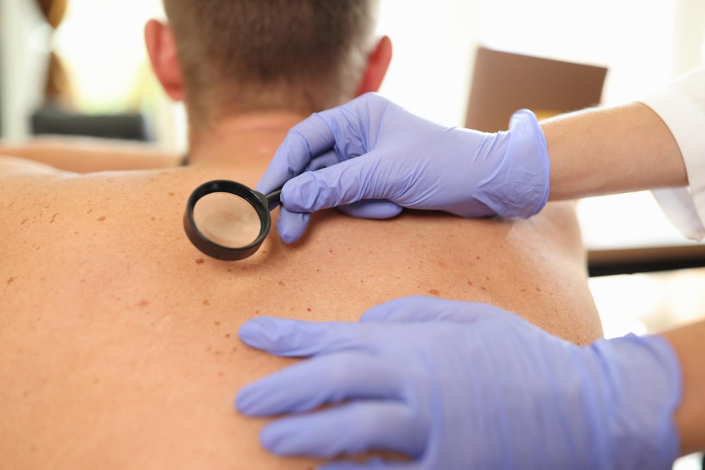 ​​Come ci si accorge di avere un melanoma?