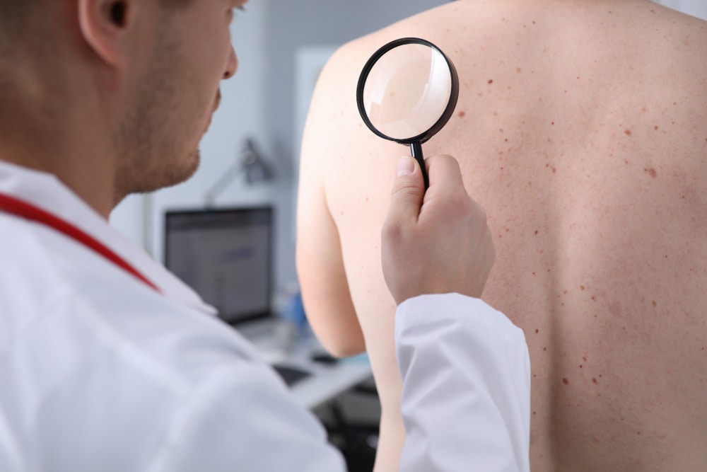 Come si riconosce il melanoma?