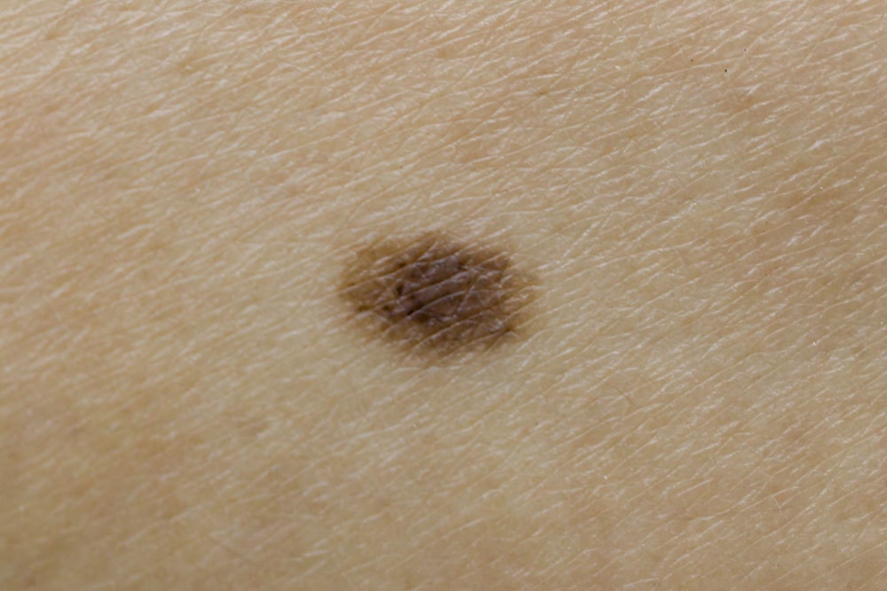 ​​Come ci si accorge di avere un melanoma?
