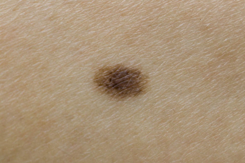 Perché fare prevenzione primaria del melanoma?