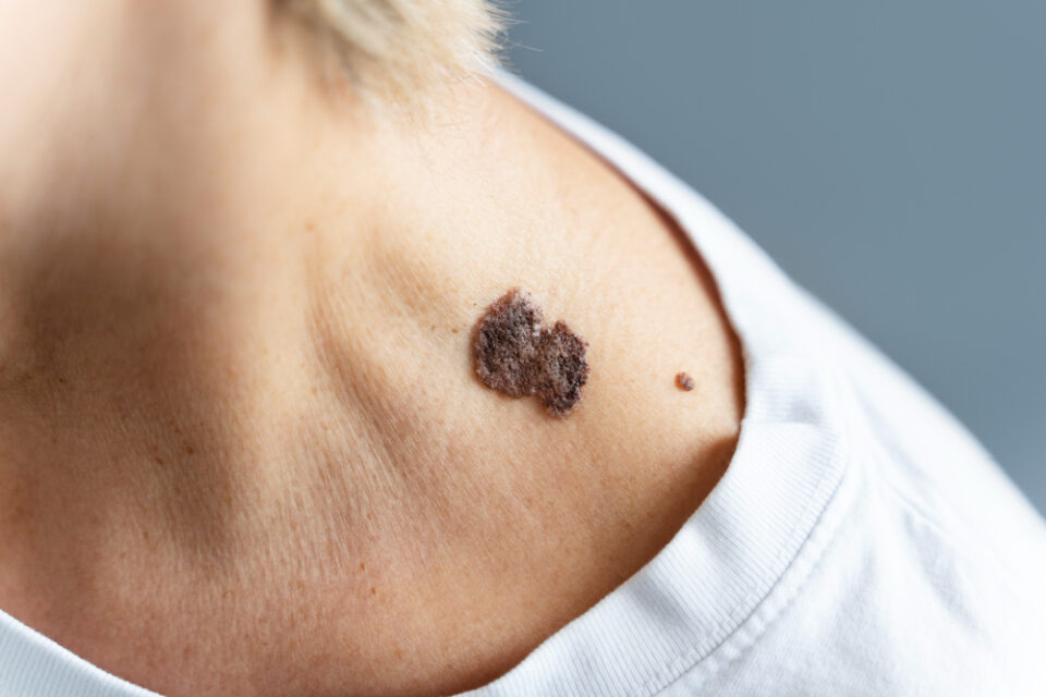 Cosa fare se viene diagnosticato un melanoma